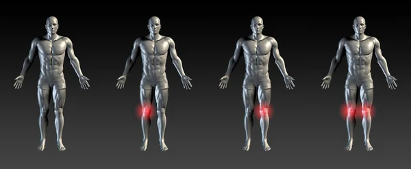 Knee Injury as Concept — Stock Photo, Image