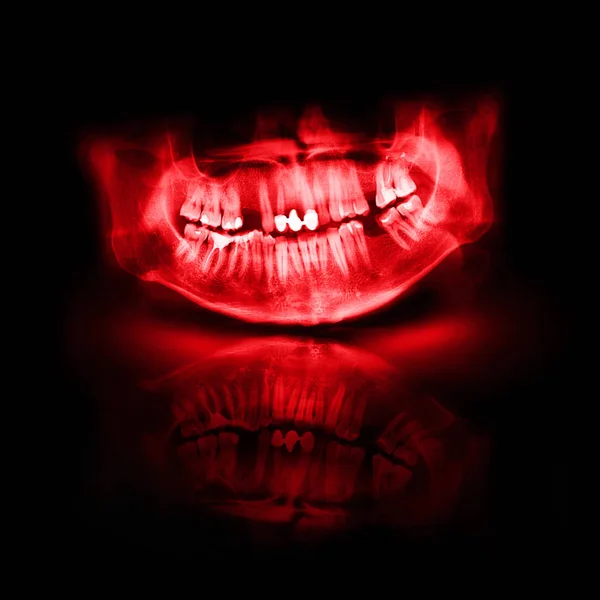 Червоний рентгенівського череп щелепи зуба — стокове фото