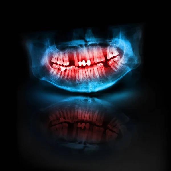 Blue and Red X-Ray Skull Jaw Tooth — Stock Photo, Image