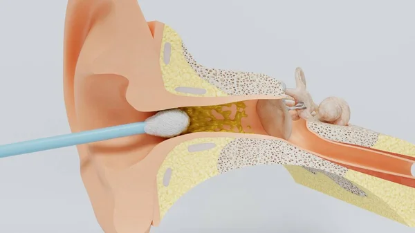 3d renderować ucho czyszczące ucho ucho kij wosku. Ilustracja 3D — Zdjęcie stockowe