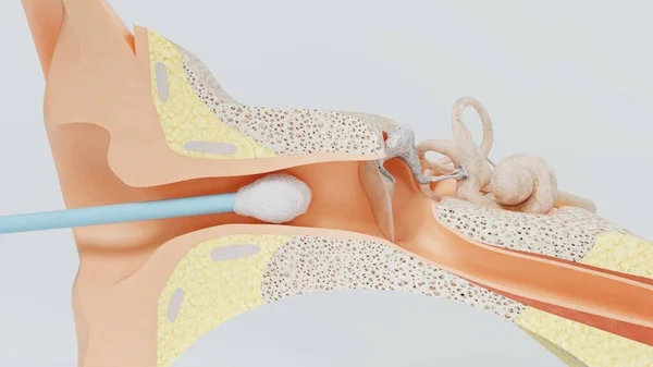 耳を3Dレンダリングクレンジング耳ワックススティック。3Dイラスト — ストック写真