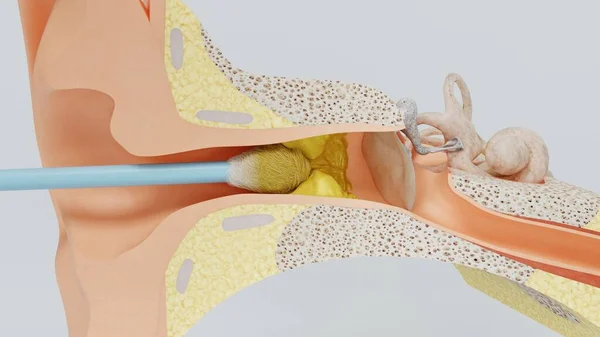 3d renderować ucho czyszczące ucho ucho kij wosku. Ilustracja 3D — Zdjęcie stockowe
