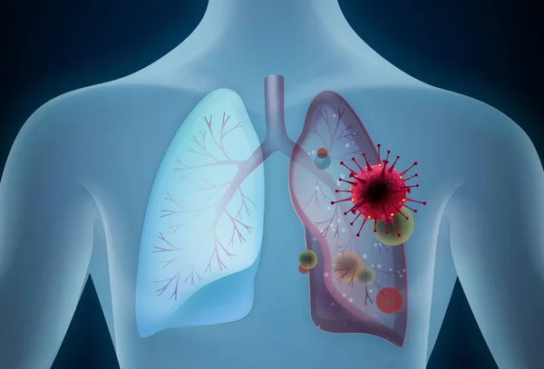 Pulmones afectados por una ilustración vectorial COVID-19 — Archivo Imágenes Vectoriales