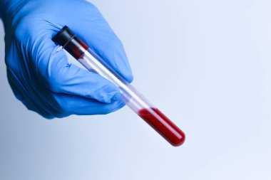 Coronavirus kan testi konsepti. Doktor elinde Coronavirus pozitif kan olan test tüpü tutan beyaz tıbbi eldiven getirdi. 2019-ncov Coronavirus kökenli Wuhan, Çin