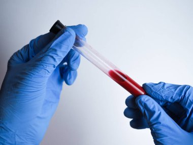 Coronavirus kan testi konsepti. Doktor elinde Coronavirus pozitif kan olan test tüpü tutan beyaz tıbbi eldiven getirdi. 2019-ncov Coronavirus kökenli Wuhan, Çin