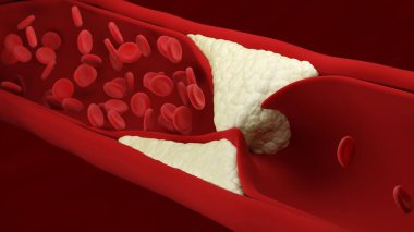 Atherosclerosis. Red blood cells.  Artery. Build up of plaque. Loss of elasticity of the walls of arteries. Thickening and hardening. Blood flow. 3d illustration. clipart