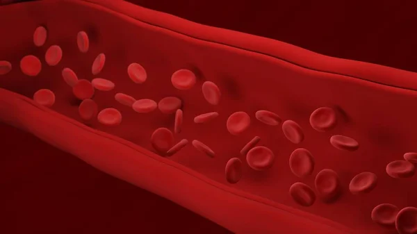 Atherosclerosis Red Blood Cells Artery Build Plaque Loss Elasticity Walls — Stock Photo, Image