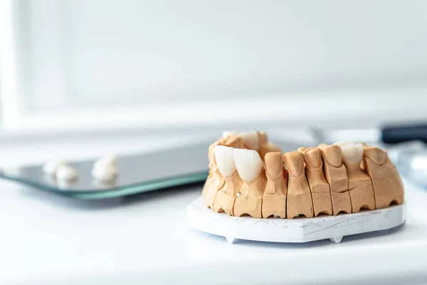 Las dentaduras postizas, carillas, coronas, implantes se hacen en un laboratorio dental —  Fotos de Stock