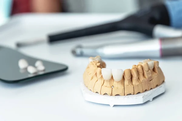 Diş laboratuvarında kaplama, Dental implantlar ve kron imalatı.