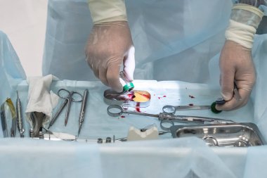 Diş implantasyonu sırasında bariyer zarını kesen bir dişçinin elleri.