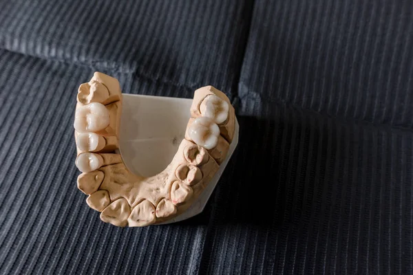 Masticar artificial con coronas y carillas de dientes hechas está de pie sobre la mesa en el laboratorio dental. Equipos técnicos y profesionales —  Fotos de Stock