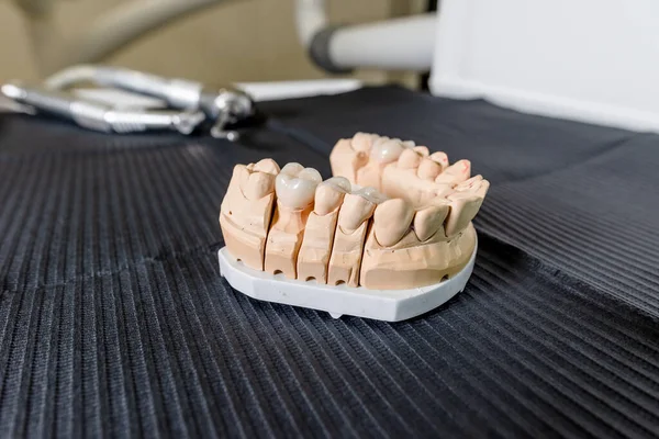 Masticar artificial con coronas y carillas de dientes hechas está de pie sobre la mesa en el laboratorio dental. Equipos técnicos y profesionales —  Fotos de Stock