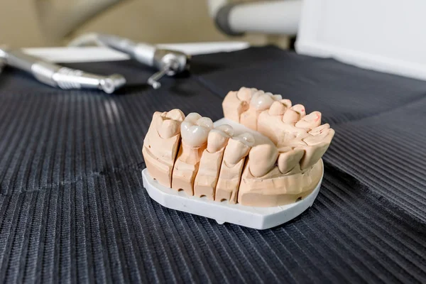 Masticar artificial con coronas y carillas de dientes hechas está de pie sobre la mesa en el laboratorio dental. Equipos técnicos y profesionales —  Fotos de Stock