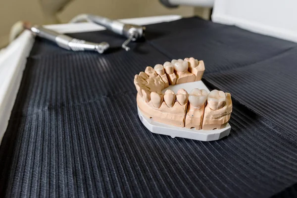 Masticar artificial con coronas y carillas de dientes hechas está de pie sobre la mesa en el laboratorio dental. Equipos técnicos y profesionales —  Fotos de Stock