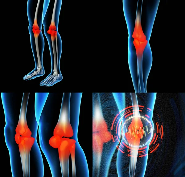Lidského kolene bolest s anatomii kostry nohy — Stock fotografie