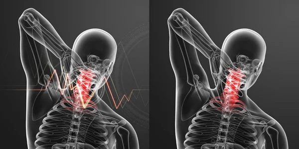 Illustrazione resa 3d - dolore al collo — Foto Stock