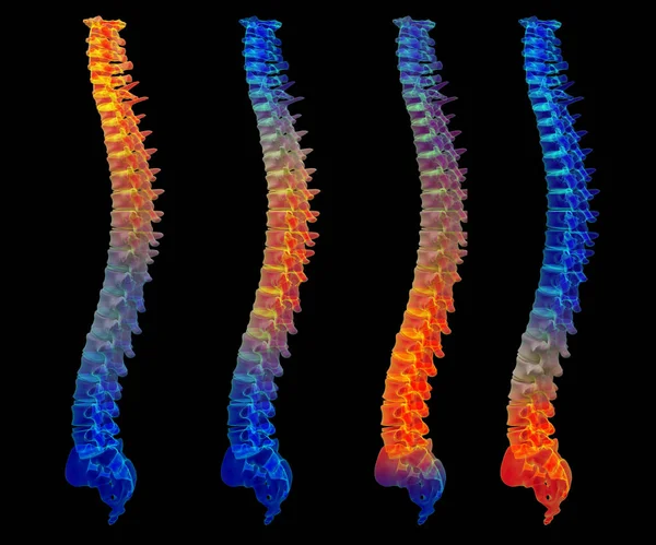 3d renderizado columna vertebral dolorosa —  Fotos de Stock