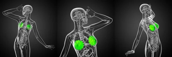3D rendering medicinsk illustration av den mänskliga bröstcancer — Stockfoto