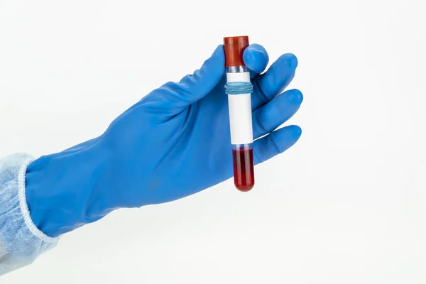 Ręcznie trzymając próbkę krwi w próżni. Pozytywny wynik testu na obecność nowego szybko rozprzestrzeniającego się koronawirusu — Zdjęcie stockowe