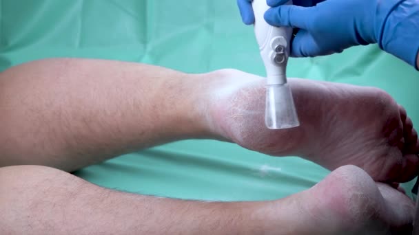 Callus Peeling Met Behulp Van Professionele Pedicure Tool Het Verwijderen — Stockvideo
