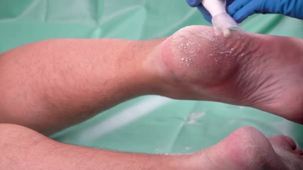 Callus Peeling Usando Ferramenta Pedicure Profissional Removendo Pele Dura Calejada — Vídeo de Stock