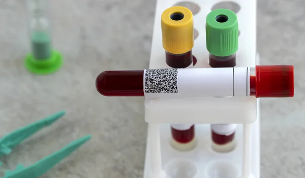 Test Obecność Koronawirusu Kolba Medyczna Badaniem Krwi Obecność Wirusa Covid — Zdjęcie stockowe