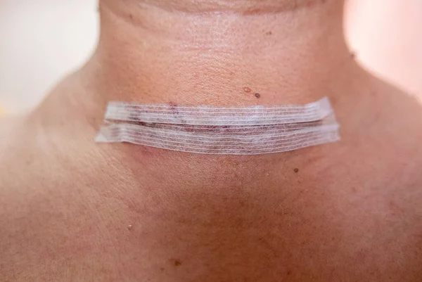 Close Thyroid Operation Scar Man Adhesive Bandage Still Intact — Stock Photo, Image