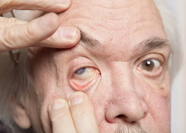 Eye disease treatment — Stock Photo, Image