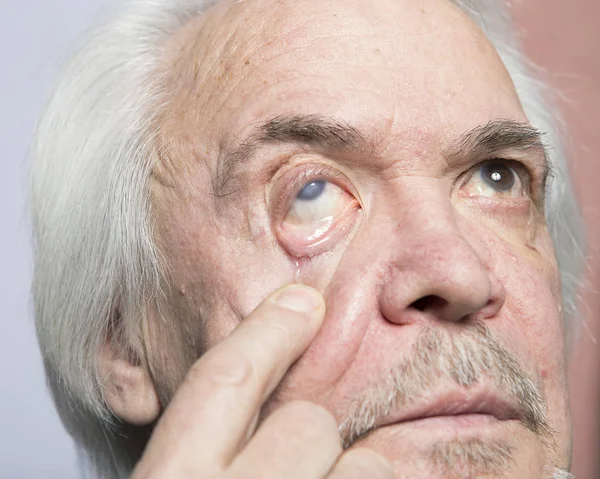 De behandeling van de ziekte van het oog — Stockfoto