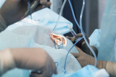 Kristal lens değiştirilebilir cerrahi yöntemi