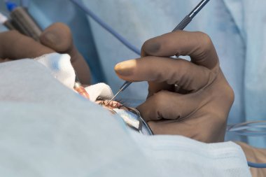 Kristal lens değiştirilebilir cerrahi yöntemi