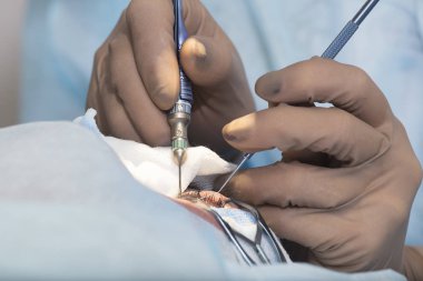 Kristal lens değiştirilebilir cerrahi yöntemi