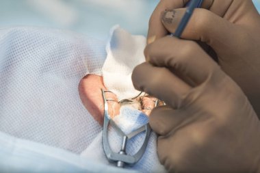 Kristal lens değiştirilebilir cerrahi yöntemi