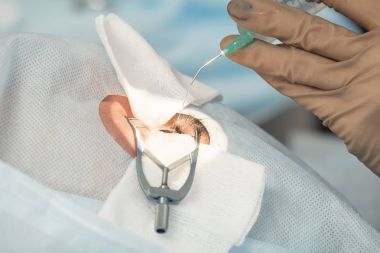 Kristal lens değiştirilebilir cerrahi yöntemi