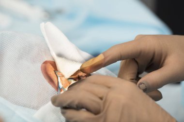 Kristal lens değiştirilebilir cerrahi yöntemi