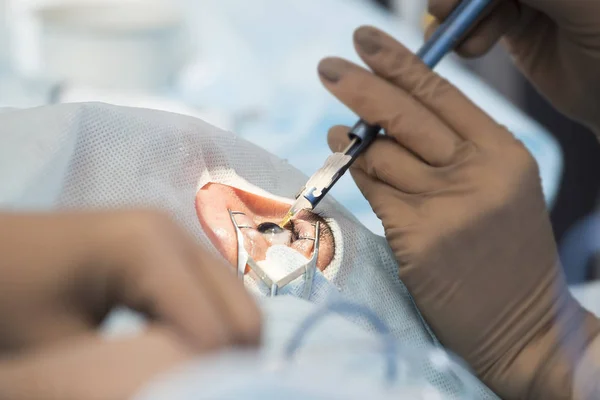 Crystalline lens replaceable surgical method — Stock Photo, Image