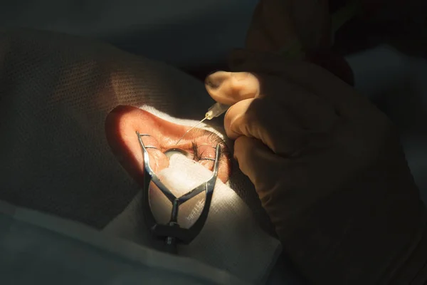 Lensa kristalin dapat diganti dengan metode bedah — Stok Foto