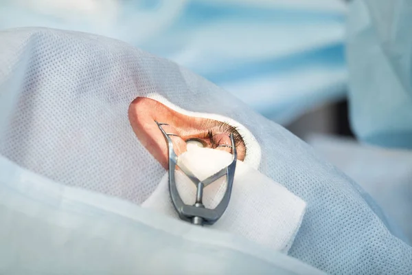 Kristallina linsen utbytbara kirurgisk metod — Stockfoto