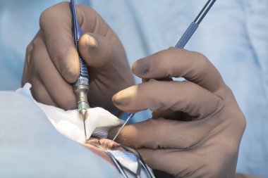 Kristal lens değiştirilebilir cerrahi yöntemi