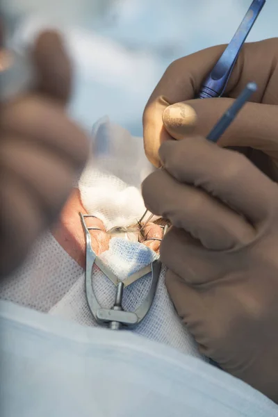 Crystalline lens replaceable surgical method — Stock Photo, Image