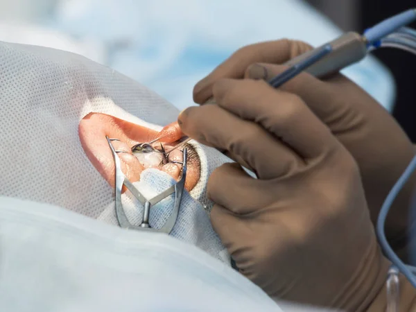 Kristal lens değiştirilebilir cerrahi yöntemi — Stok fotoğraf