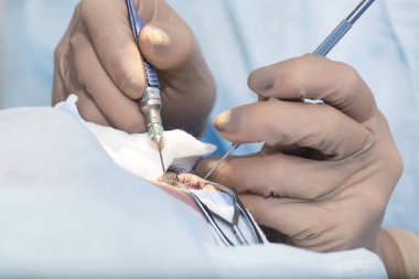 Kristal lens değiştirilebilir cerrahi yöntemi