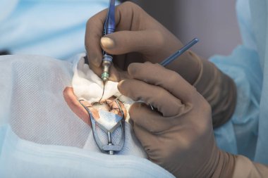 Kristal lens değiştirilebilir cerrahi yöntemi