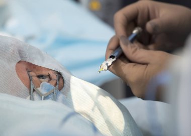 Kristal lens değiştirilebilir cerrahi yöntemi