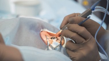 Kristal lens değiştirilebilir cerrahi yöntemi