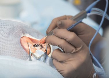 Fakoemülsifikasyon, göz b opak objektif imha