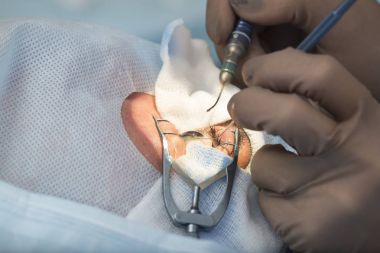 Fakoemülsifikasyon, göz b opak objektif imha