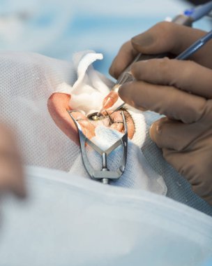 Kristal lens değiştirilebilir cerrahi yöntemi