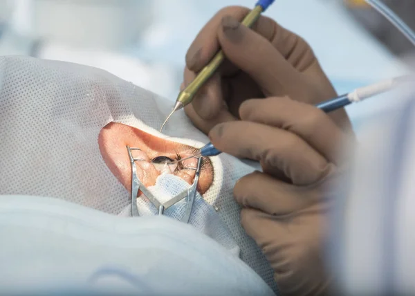 Facoemulsificación, destrucción de la lente opaca del ojo b — Foto de Stock