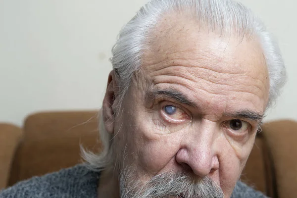 Augenkrankheit bei einem alten Mann — Stockfoto